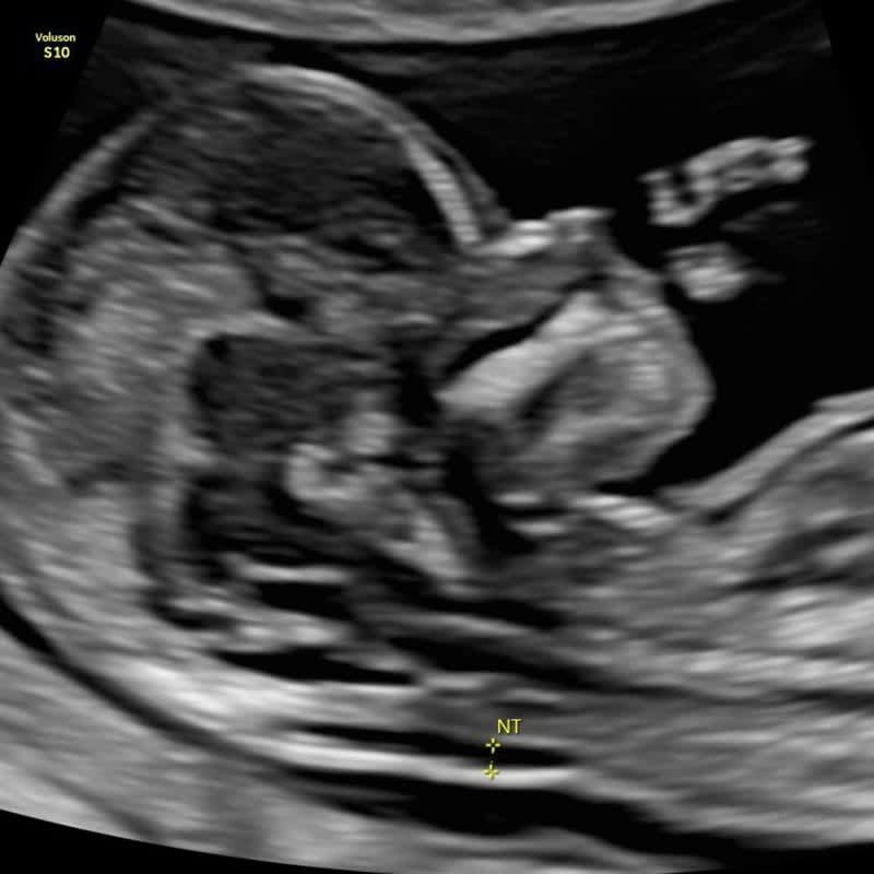Ansiedad embarazo primer trimestre