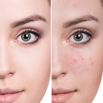 Caracteristicas del acne por estres