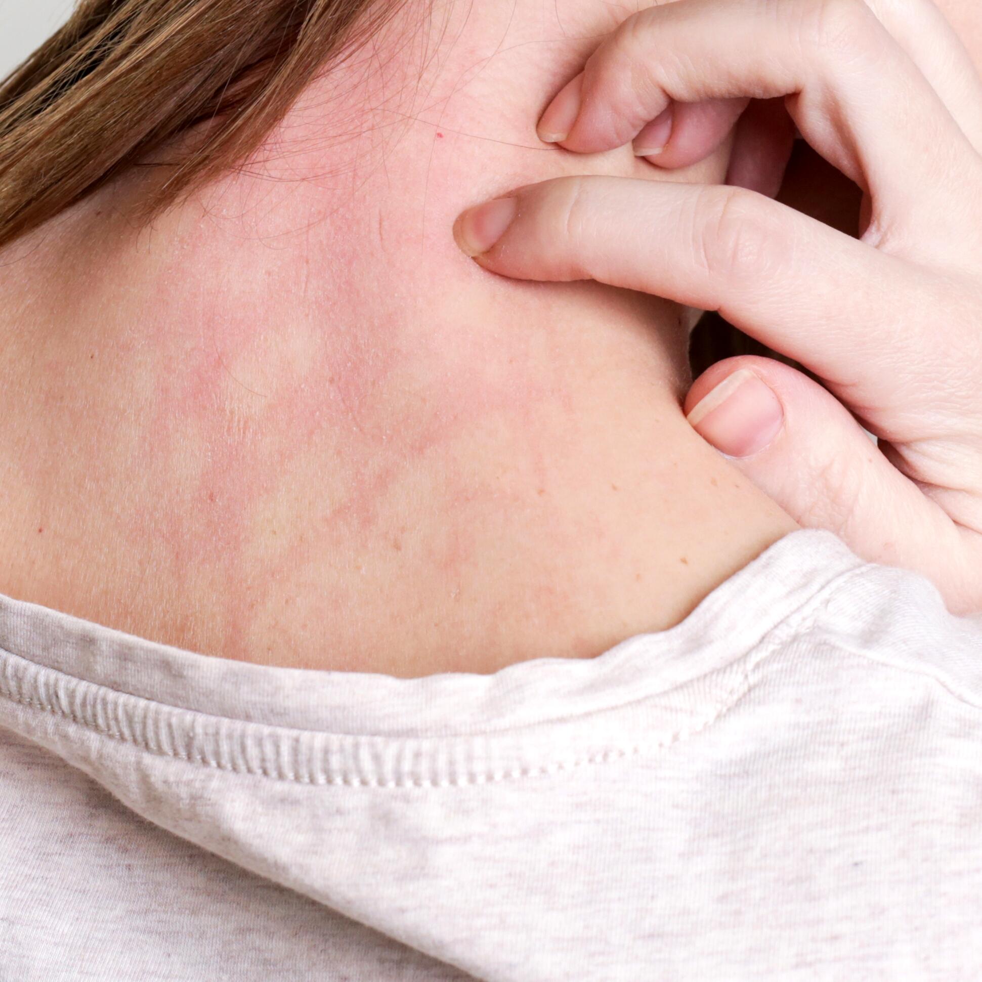 Como curar la dermatitis por estres Actualizado octubre 2022