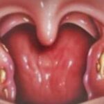 Como aliviar dolor de cabeza por estres