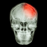 Bulto detras de la cabeza con dolor