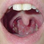 Dolor de cabeza y sudor frio en niños