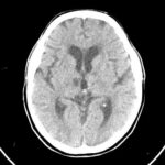Postherpetic neuralgia treatment carbamazepine