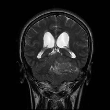 Ectasia ductal en la menopausia