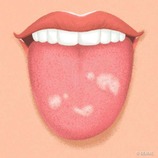 Manchas blancas en la lengua por estres