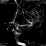 Neuralgia del trigemino tratamiento con acupuntura