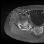 Mioclonias en las piernas por estenosis lumbar