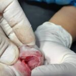 Como curar la insolacion dolor de cabeza