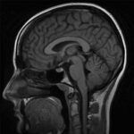 Dolor de cabeza parietal y occipital