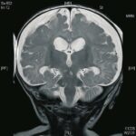 Trastorno de ansiedad generalizada y dolor de cabeza constante