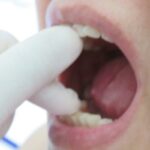 Postherpetic neuralgia treatment carbamazepine