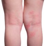 Dolor de cabeza por ansiedad y falta de dormir