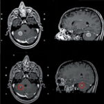 Arteritis temporal por estres