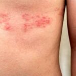 Dolor de cabeza al comer grasa